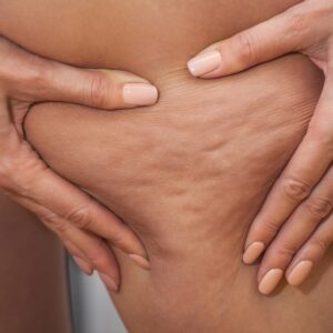 Fact or fiction: Cellulite is a build-up of toxins from a bad diet